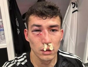 Beşiktaş: “Zaynutdinov’un burnunda ve göz çukurunda kırık saptanmıştır”